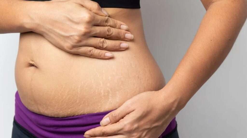 Stretch Marks