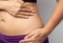 Stretch Marks
