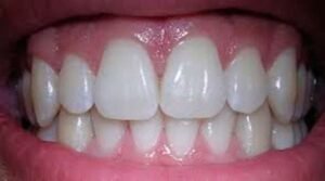 White teeth tips
