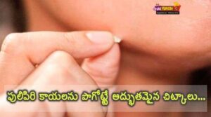 How to Remove Warts