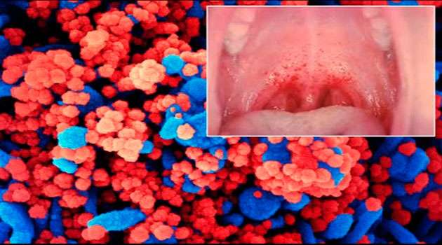 Sore Tongue A Sign Of Coronavirus