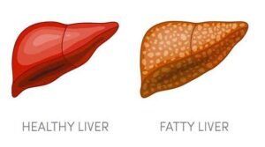 Fatty liver problem In Telugu