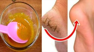 cracked heels home remedies in Telugu