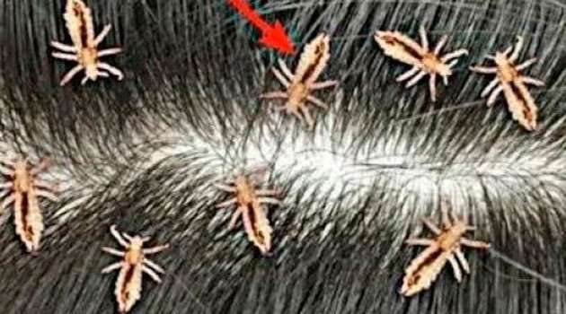 Hair lice remove tips In Telugu