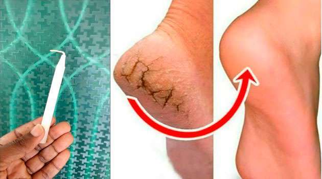 పాదాల పగుళ్లతో ఇబ్బంది పడుతున్నారా? ఇంట్లోనే ఈ ఒక్క చిట్కాతో పగుళ్లు మాయం!