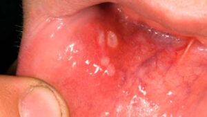 Mouth Ulcers