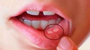 Best home remedy for Mouth Ulcers in Telugu