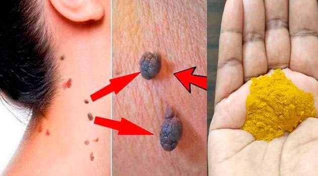How to Remove Warts in Telugu