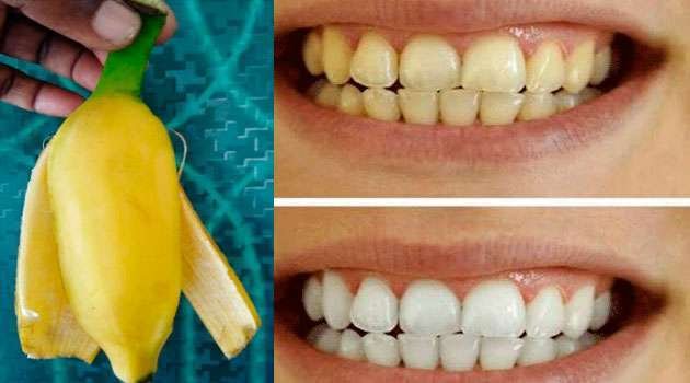 White Teeth:ఇలా చేస్తే చాలు 5 నిమిషాల్లో పళ్లపై ఉన్న గార,పసుపు పోయి తెల్లగా మెరుస్తాయి