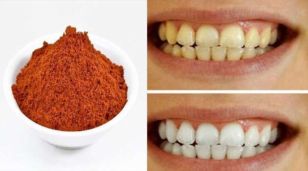 Yellow Teeth Home Remedies