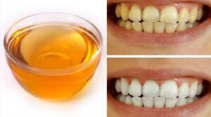 Yellow teeth home remedies