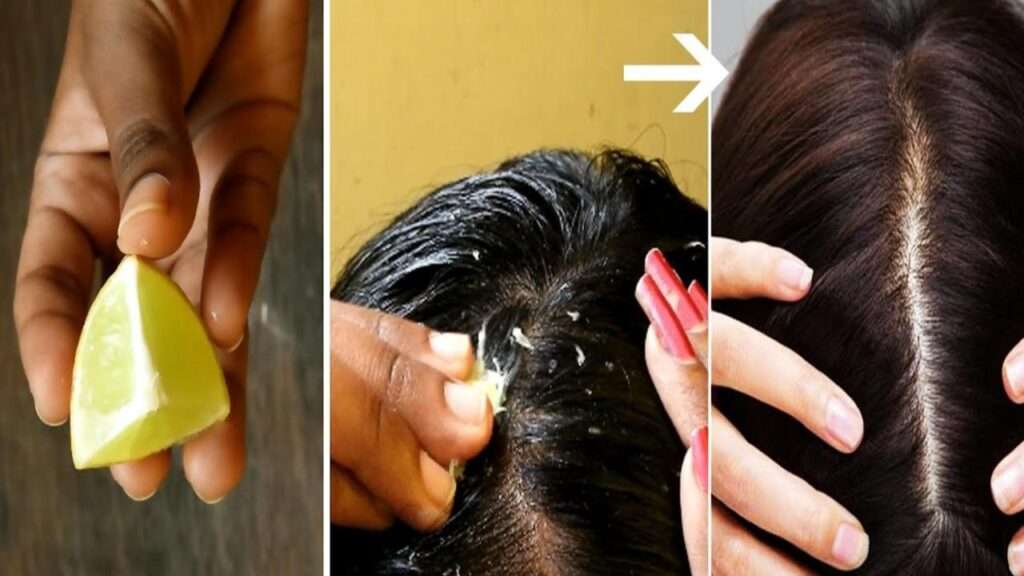 lemon dandruff