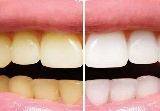 cropped-yellow-teeth.jpg