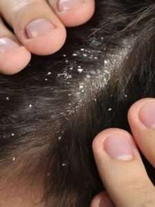 cropped-dandruff.jpg