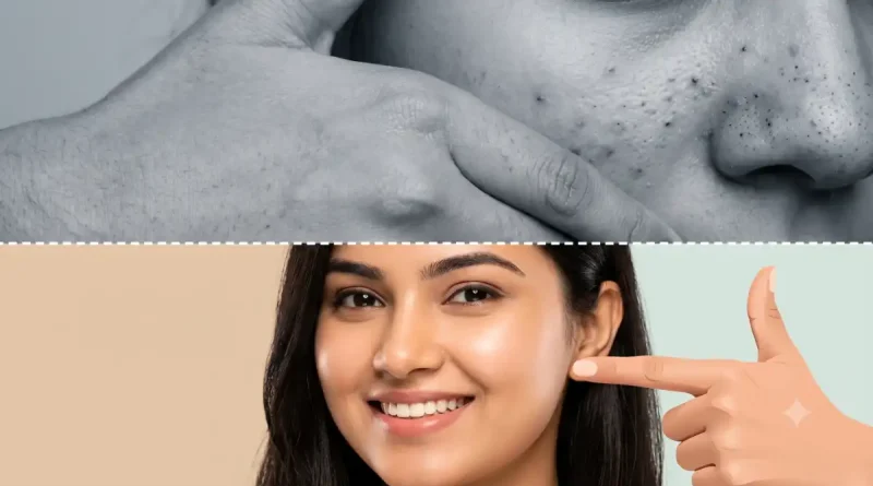 Black Heads home remedies