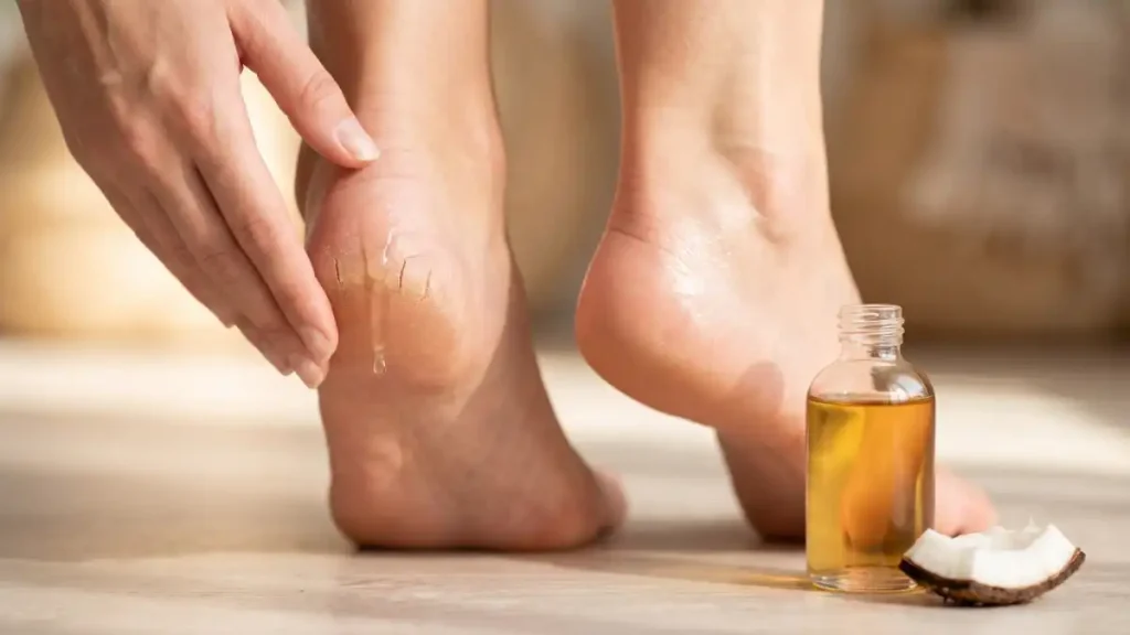 Cracked heels home remedies