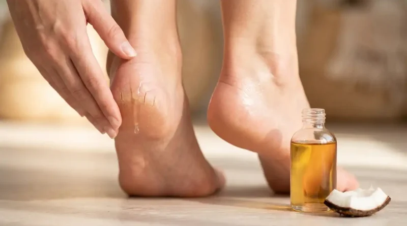 Cracked heels home remedies